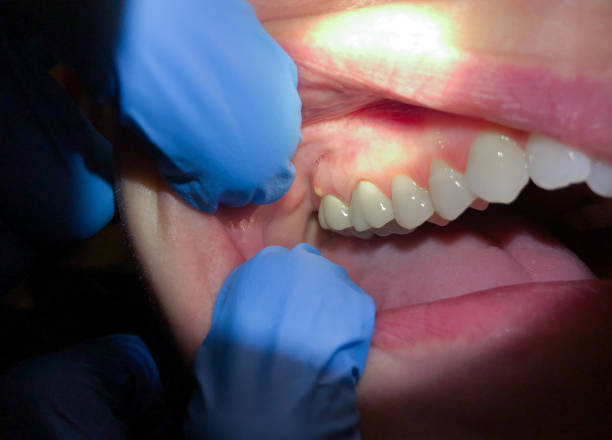 Best Emergency Cosmetic Dentistry (e.g., broken veneers) in Young Harris, GA